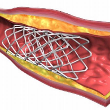 Ion Iliescu, la al saselea stent cardiac