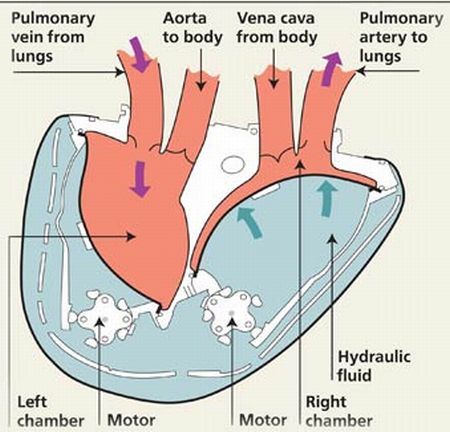 Inima artificială perfectă, în mâinile doctorilor francezi
