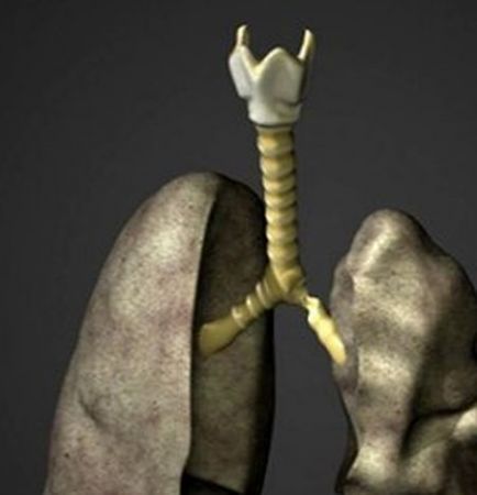 Primul transplant de organ "prelucrat" cu celule stem