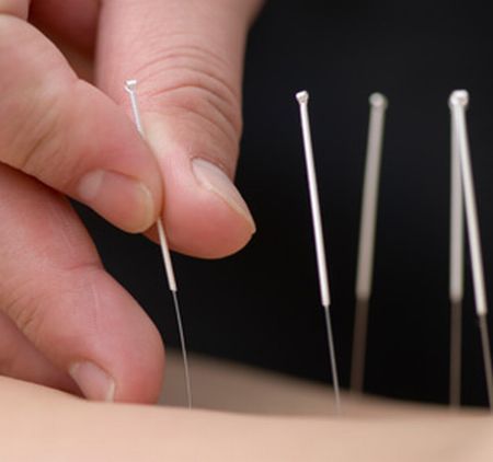Mitul acupuncturii împotriva durerilor, demolat