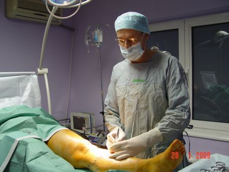 Trataţi-vă din timp varicele!