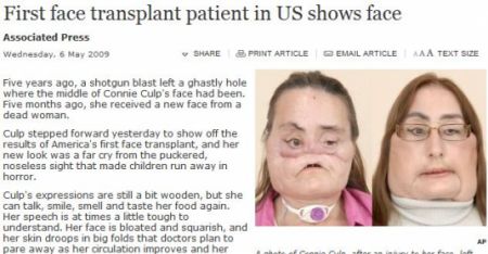 Pacienta primului transplant de faţă în SUA îşi dezvăluie identitatea