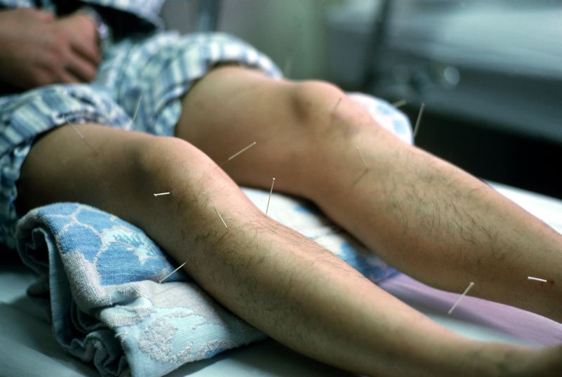 Acupunctura, sursă de infecţii