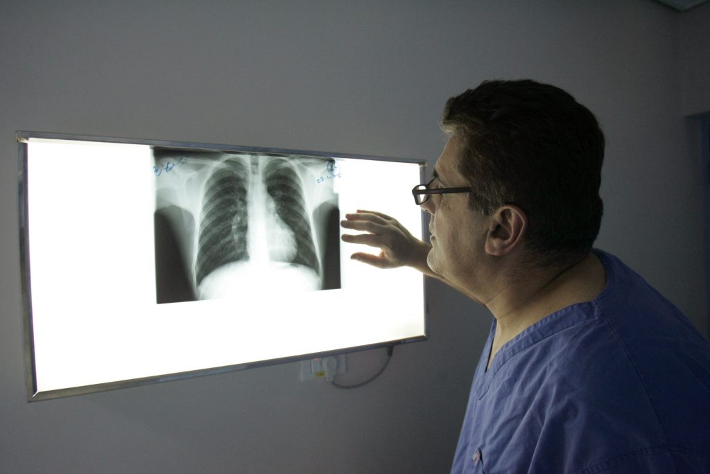 Pastila pentru cancer la plămâni care dă cea mai mare rată de supraviețuire