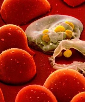 Tratamentele anti-HIV grăbesc îmbătrânirea și apariția bolilor cardiace