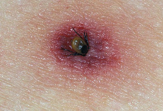 Peste 100 de cazuri de muşcături de căpuşe, 17 îmbolnăviri cu Lyme