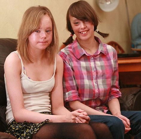 Singurele surori cu „piele de şarpe” din Regatul Unit