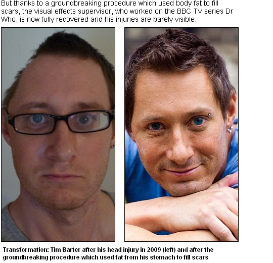 PROCEDURĂ REVOLUȚIONARĂ. Bărbatul cu gaură în cap, vindecat cu grăsime din stomac