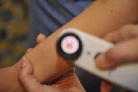 Cu alunițele, la control! Program gratuit de depistare a cancerului de piele