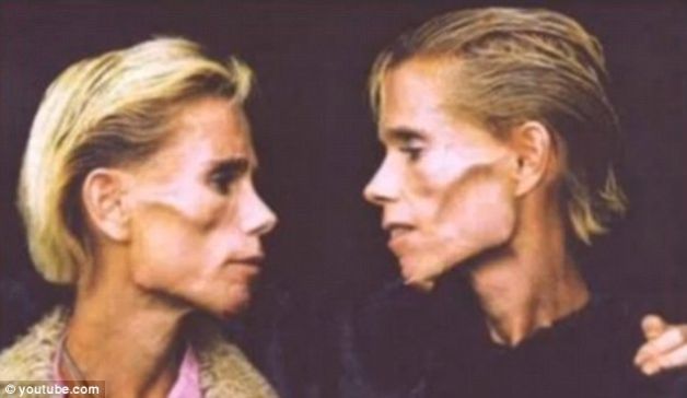 La 42 de ani cântăreau 25 de kilograme. Incredibila poveste a gemenelor anorexice care şi-au prezis moartea | VIDEO