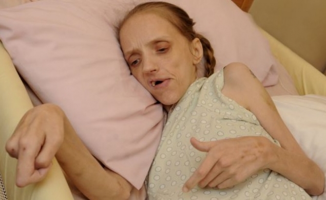 N-ai văzut aşa ceva! Cum arată o femeie care a băut timp de 10 ani, 40 de cutii de bere şi un litru de cidru pe zi