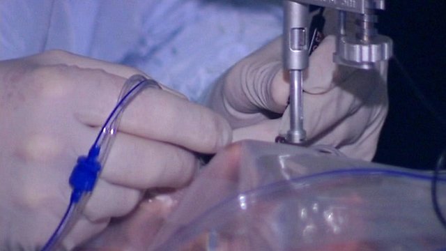 Orbirea ar putea fi tratată prin terapie genetică