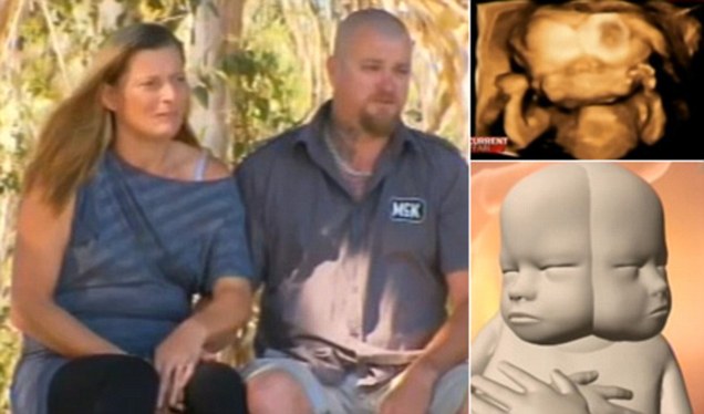 Copilul care se va naşte cu DOUĂ CREIERE şi DOUĂ FEŢE. Medicii nu îi dau NICIO ŞANSĂ, dar părinţii lui au luat o DECIZIE ŞOCANTĂ