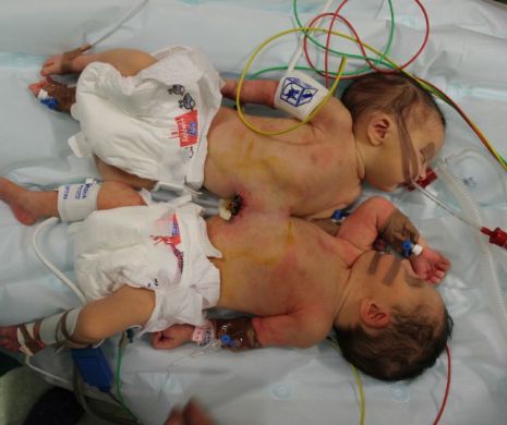 Siamezele s-au reîntâlnit cu mama lor