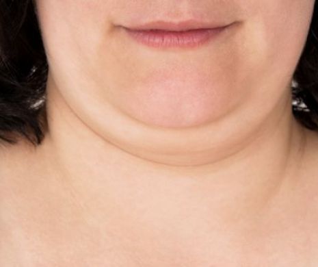 Cum să scapi de gușă