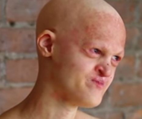 Suferă de o boală cumplită care o desfigurează, dar este un MODEL CELEBRU cu milioane de fani!