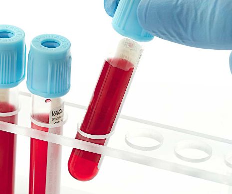 Cancerul de sân, depistat printr-un simplu test de sânge
