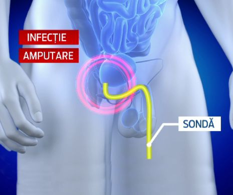 ANIMATIE GRAFICA. Cum i-a fost amputat penisul unui barbat din Buzau. Cere daune de 500.000 de euro