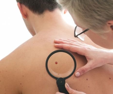 Riscul de CANCER de piele este foarte mare dacă îţi rupi o ALUNIŢĂ şi nu mergi la doctor