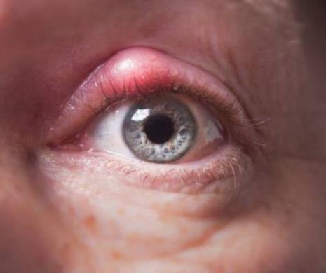 Ulciorul, simptome si tratament. Cum scapi de el rapid