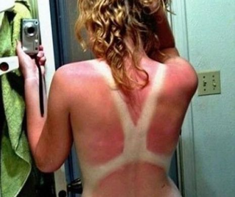 Avertisment venit din partea dermatologilor. Melanomul, cel mai AGRESIV tip de cancer de piele, e din ce în ce mai des întâlnit | GALERIE FOTO