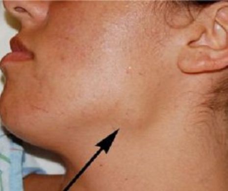 Ganglionii măriți pot ascunde cancer sau infecții. Când trebuie să vă îngrijorați?