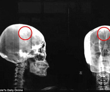 INCREDIBIL. Ce i-au descoperit medicii în creier unei femei care se plângea des de dureri de cap