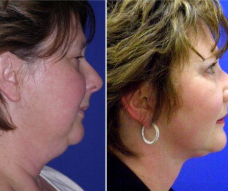 Patru exerciții simple care te scapă de gușă