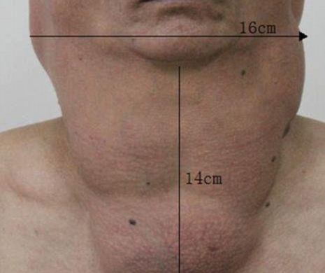 MONSTRUL cu gât de CAL. A băut prea mult ALCOOL şi a ajuns să arate ca UN HIPOPOTAM!  | VIDEO