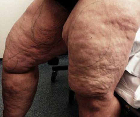 A slăbit 60 de kilograme dar nu putea să scape de grăsimea de pe coapse. De vină era o boală cronică