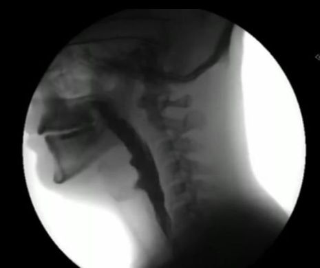 IMAGINI SPECTACULOASE din timpul hidratării. RADIOGRAFIA CU RAZE X arată cum curge lichidul pe gât