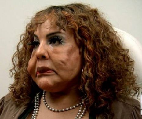 A ramas desfigurata, dupa ce i-a fost injectat ciment in fata, iar doctorii au refuzat sa o opereze: cum arata chipul femeii