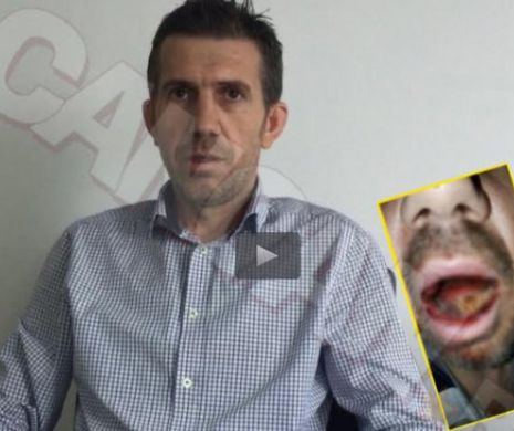 ”M-au desfigurat la manele!” Acest barbat sustine ca a fost batut de un milionar