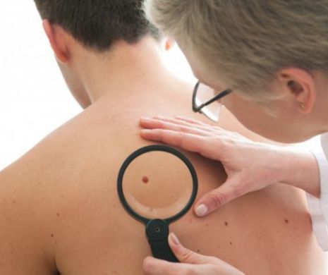 Toamna „se numără” alunițele! Depistarea precoce a cancerului de piele