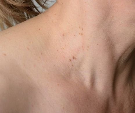 Uite care este tratamentul în caz de veruci