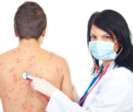 Remedii naturale pentru ameliorarea simptomelor de varicela