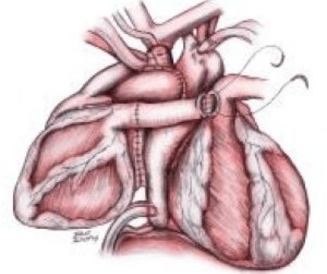 ŞOCANT. De ce OAMENII cu două INIMI reprezintă viitorul