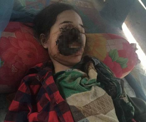 DESFIGURATĂ de BACTERIA cu care a fost infectată în timpul unei banale intervenții stomatologice. Medicii sunt îngroziți