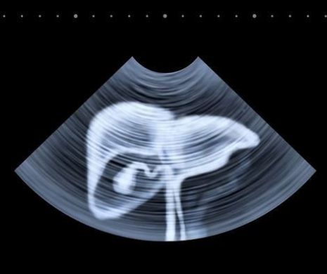 Tratament clasic pentru ciroza biliară primitivă