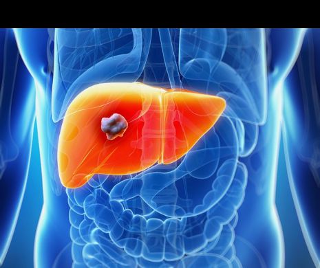 În mai puţin de 40 de ani, numărul MORŢILOR cauzate de CANCER s-a DUBLAT