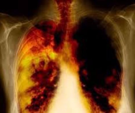 Consumul de GRĂSIMI SATURATE dezvoltă CANCERUL PULMONAR