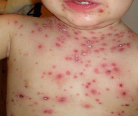 Epidemie de RUJEOLĂ. S-a ajuns la peste 10.000 de cazuri. Peste 100 de îmbplnăviri doar în ultima săptămână