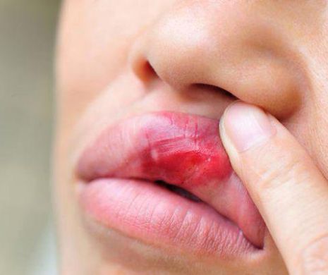 Cancerul cavitatii orale: simptomele de debut trec neobservate