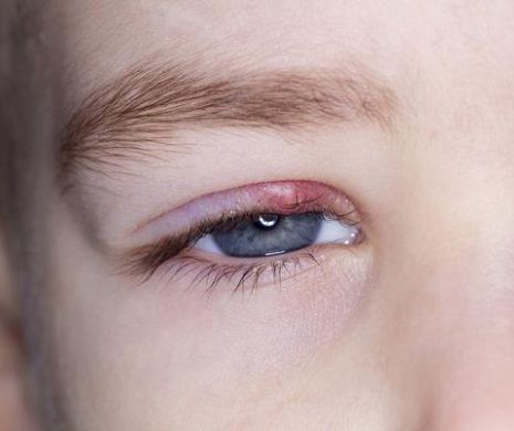 Amestecul de plante care vindeca urciorul