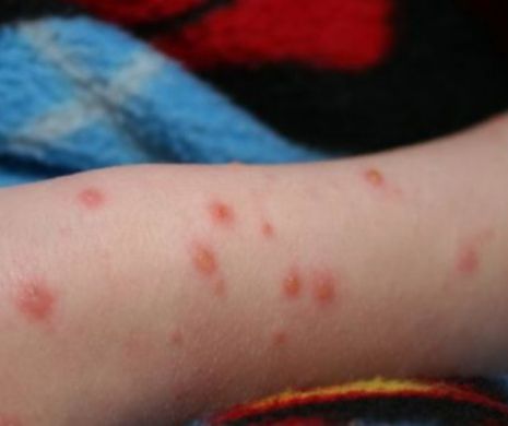 RUJEOLA lovește din nou! Avem 55 de DECESE, iar ULTIMA VICTIMĂ e un bebeluș de 3 luni din Iași