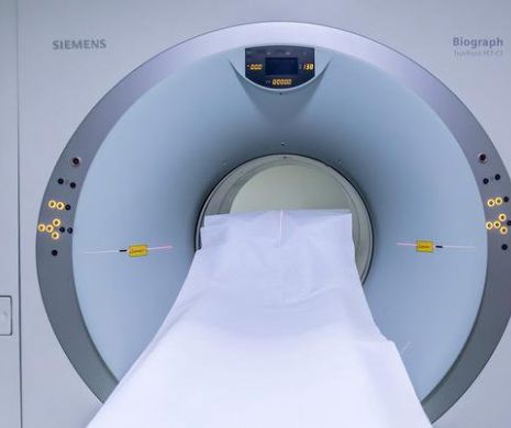 Ai observat că pupila s-a micșorat puțin și pleoapa este mai căzută? Uite care este sindromul de care suferi