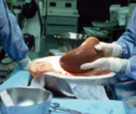 Transplantat de ficat de la o femeie de 97 de ani la una de 64 de ani. Tehnica „bătrân pentru bătrân”