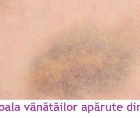 Boala vânătăilor apărute din senin.   Atacă din ce în ce mai multe femei!