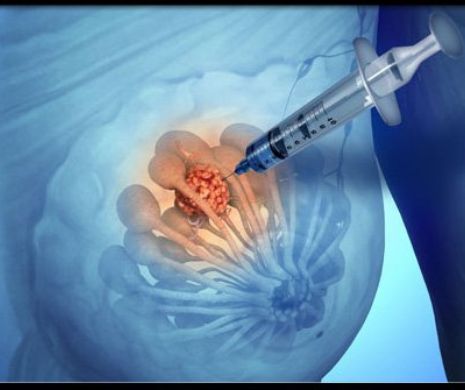 Descoperire incredibilă! Un leac pentru lepră poate fi folosit în tratamentul cancerului de sân
