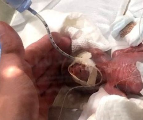 Incredibil. A fost născut cel mai mic bebeluş din lume. Nu avea mai mult decât greutatea unui măr